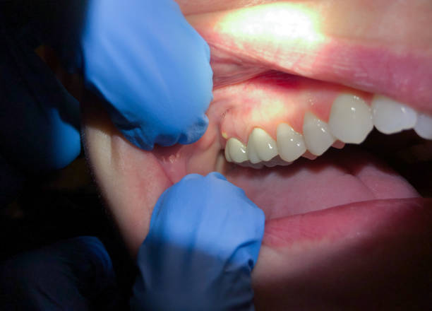 Best Emergency Dental Care for Broken or Chipped Teeth in Haverhill, FL